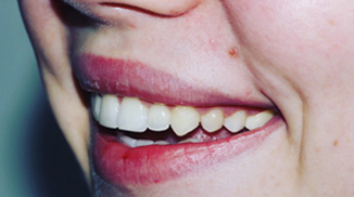 After - ElegantSmiles